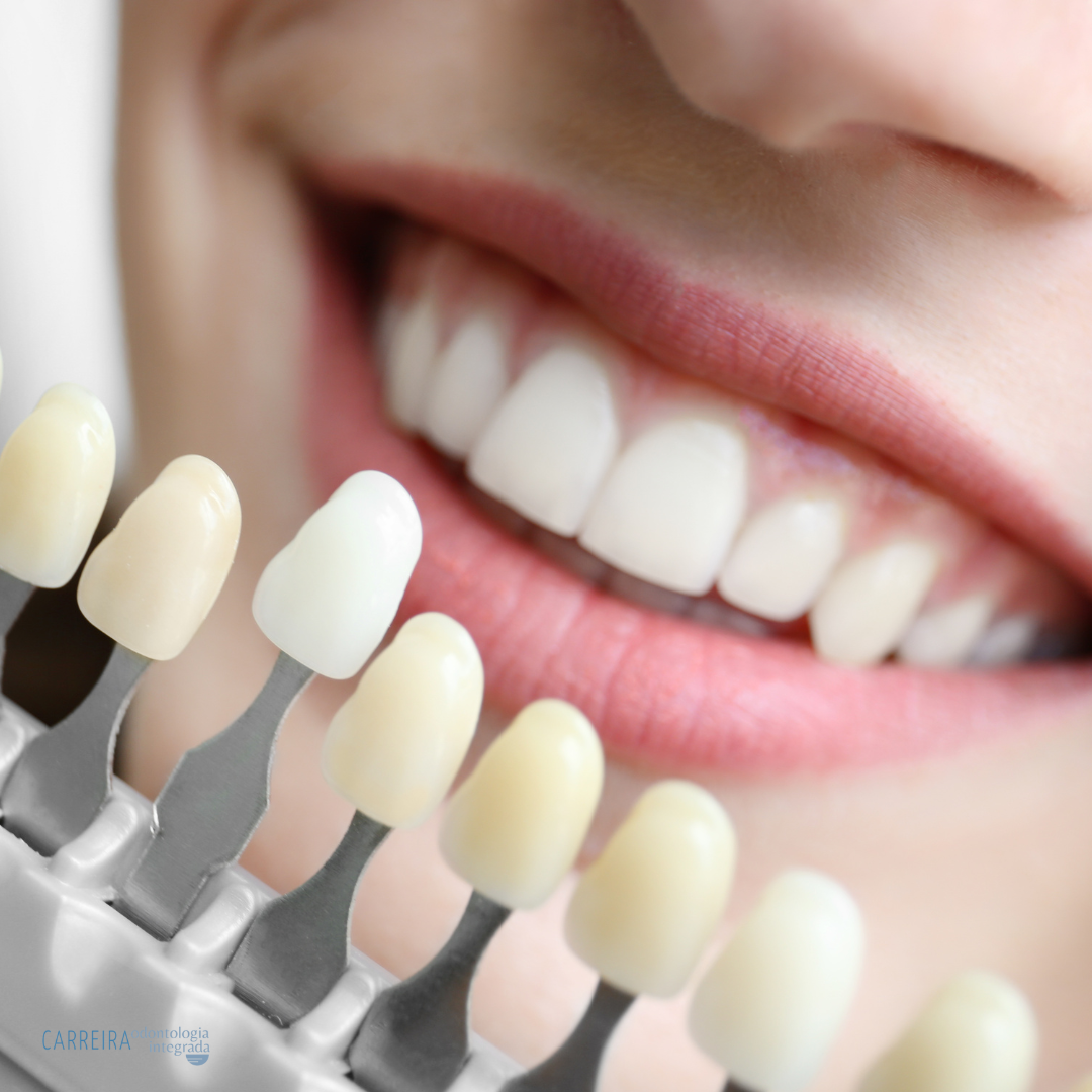 Clareamento Dental: Tudo o que você precisa saber para conquistar um sorriso mais branco